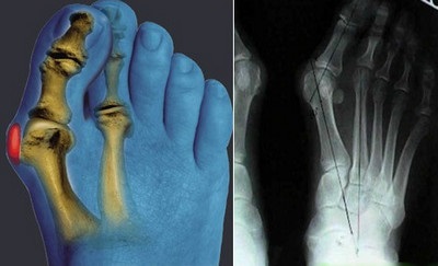 Osteoarthritis a láb tünetek és kezelések a betegség