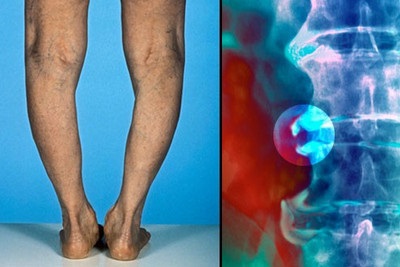Osteoarthritis a láb tünetek és kezelések a betegség