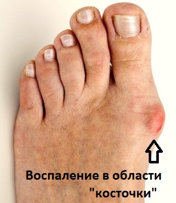 Kereszt lúdtalp tünetei és kezelése Moszkva, műtéti kezelése deformitás Moszkvában