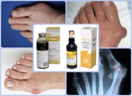 Az orvosi epe csontok lábukon szabály ellenjavallatok kezelés vélemények