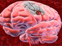 Megelőzés agyi stroke (ischaemiás vagy vérzéses) kábítószerek és a népi
