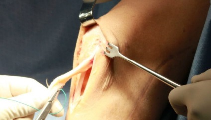 Eltávolítását a meniszkusz és helyreállítási a műtét után a térd meniscus