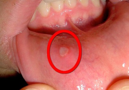Trichomonas tünetek a szájban