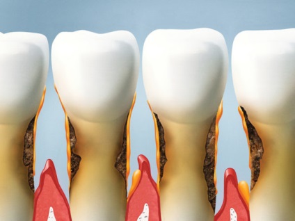 A tünetek és jelek periodontitis, diagnózis (X-sugarak és más módszerek fogászati ​​tanulmányok), beleértve a