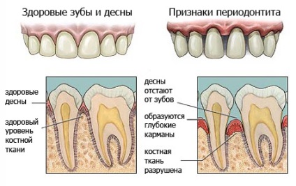 A tünetek és jelek periodontitis, diagnózis (X-sugarak és más módszerek fogászati ​​tanulmányok), beleértve a