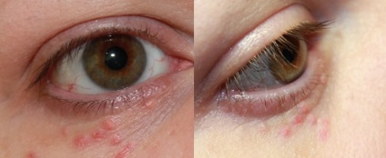 Siringoma a szem alatt - kezelésére és ártalmatlanítására siringomy