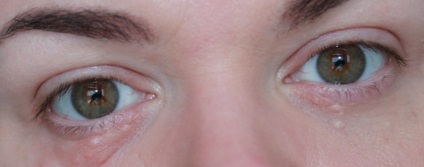 Siringoma a szem alatt - kezelésére és ártalmatlanítására siringomy