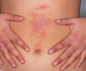 Staphylococcus aureus a bőrtünetek és a kezelés