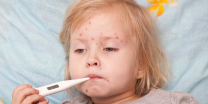 Bárányhimlő gyermekek fotók, tünetei és kezelése, valamint a védőoltás