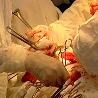 Típusai vesekő (betegség példái közé tartozik a következő) Típusú vesekő
