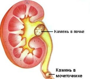 Típusai vesekő (betegség példái közé tartozik a következő) Típusú vesekő