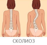 Égő nyaki osteochondrosis - nyelv a fejét jobbra, hát, láb, mellkas, arc, száj, az