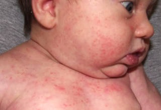 Allergia marhahús - tünetei és kezelése a gyermek és felnőtt