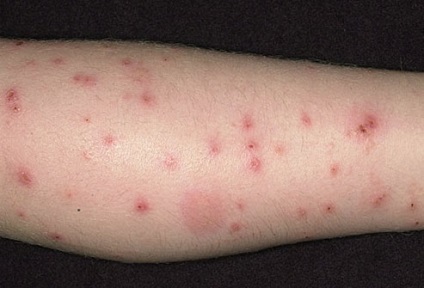 Allergiás a hangya kezelést, a tünetek