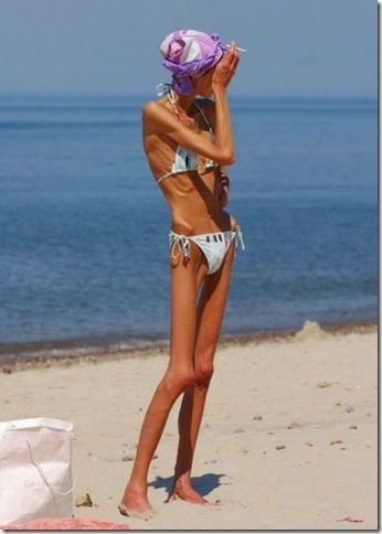 Anorexia, mint egy életmód (anorexia) Anorexia mint életmód