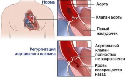 Aorta elégtelenség okoz, tünetek és a kezelés