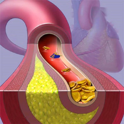 Aorta elégtelenség okoz, tünetek és a kezelés