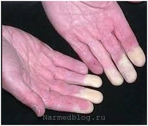Raynaud-kór, a tünetek, fotó (betegség) Raynaud-kór, a tünetek, fotók