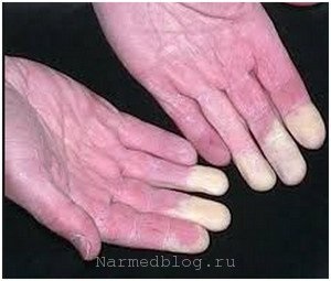 Raynaud-kór, a tünetek, fotók