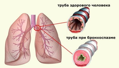 Bronchospasmus tünetek felnőttek és gyermekek, okai, kezelése, és hogyan kell eltávolítani