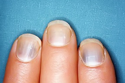 fekete köröm betegség nail fungus olcsó analógok