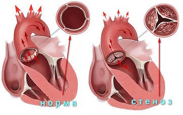 Mi mögött a diagnózis aorta visszaáramlás