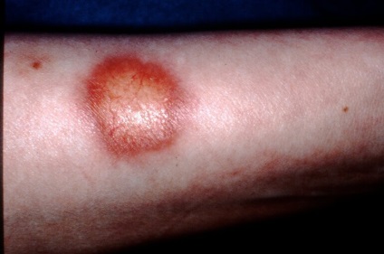 Diabetikus necrobiosis lipoid bőrápoló Photo