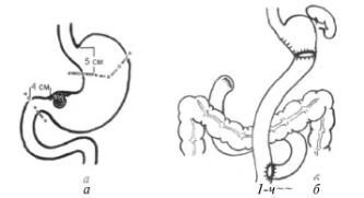 Disztális és proximális subtotalis gastrectomia