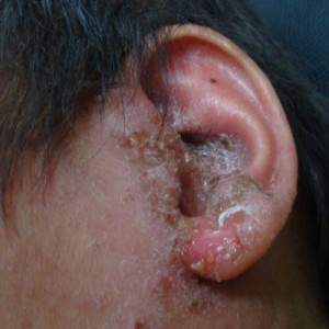fül ekcéma tünetei van egy piros viszkető folt a gyomorban