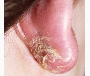 Ekcéma (dermatitis, seborrhoea) fül kezelés, a jelek és tünetek