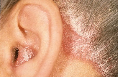 fül ekcéma tünetei