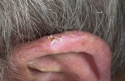 Ekcéma kezelés fülzúgás, tünetei és okai