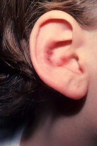 Ekcéma a fülben - okok, tünetek, kezelés, megelőzés