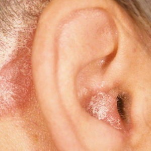 fül ekcéma tünetei
