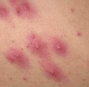 Folliculitis gyulladás (szőrtüsző) okozza és a kezelés