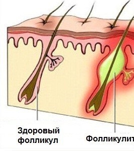 Folliculitis gyulladás (szőrtüsző) okozza és a kezelés