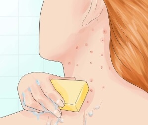 Folliculitis gyulladás (szőrtüsző) okozza és a kezelés