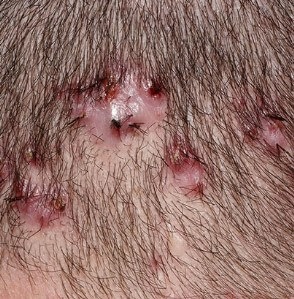 Folliculitis gyulladás (szőrtüsző) okozza és a kezelés