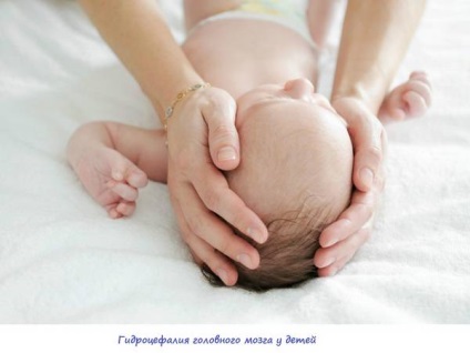 agy hydrocephalus gyermekeknél a tünetek, jelek, a betegség kezelésében