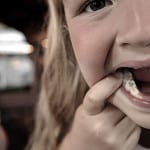 Rothadó fogak fotó gyerek, miért rothadó és mit kell csinálni
