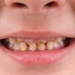 Rothadó fogak fotó gyerek, miért rothadó és mit kell csinálni