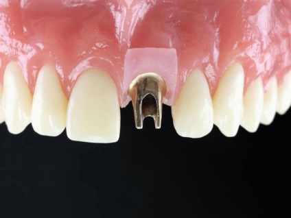 Melyik implantátum jobb, hogy az első fogak, és miért
