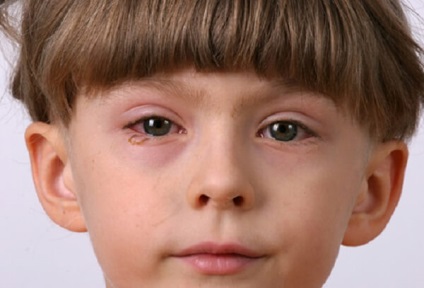 Csepp allergiában gyerekeknek