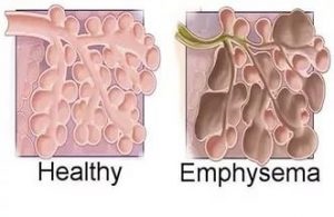 Pulmonális fibrózis és az emfizéma, mind a férfiak és a nők