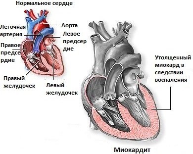 Szívizomgyulladás - etiológia, patogenezis, diagnózis, kezelés, megelőzés, az egészségügyi és az orvostudomány