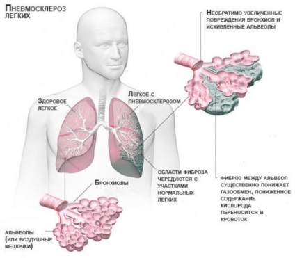 Focal fibrózis, a tüdő, hogy ez a kezelés a helyi változások, tünetek és diagnózis