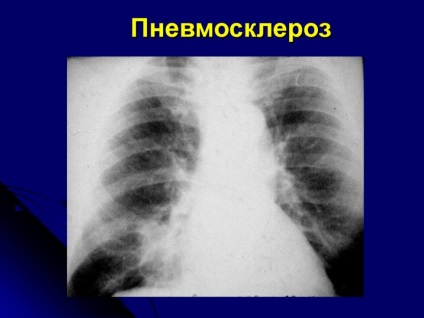 Tüdőfibrózis - a várható élettartam, okok, kezelés, eredmény