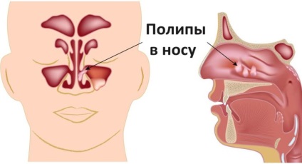 Polipok arcüreg - kezelés és tünetek