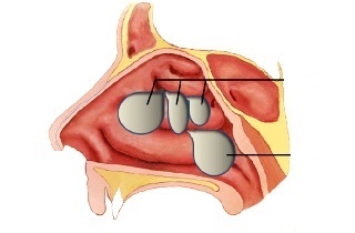 Polipok a maxillaris és arcüreg - tünetek és eltávolítási technikák