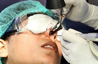 Polipok a maxillaris és arcüreg - tünetek és eltávolítási technikák